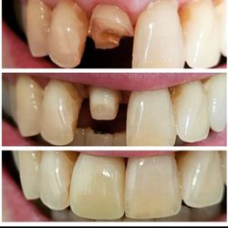 Fakhoury, Nicolas W DMD - Same visit from a broken tooth to. A beautiful in office Milled crown