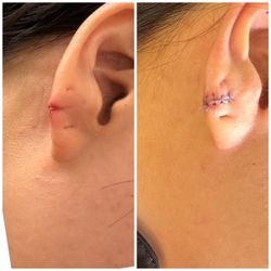 Golden Dermatology - Torn earlobe repair with Dr. Rhoutt!