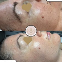 Eastvale Esthetics - Anti-aging collagen stimulating PCA chemical peel. Facial treatment brightening minimize wrinkles  lines.