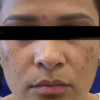 Vivi Dieppa - How I looked after - Estheticians Near Me - Doral, Florida Vivi Dieppa - How I looked after - Estheticians Near Me - Doral, Florida