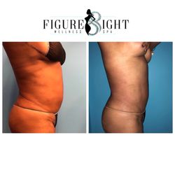 Figure 8ight Wellness Spa - PureSculpt Body