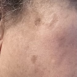 LightRx - Charlotte - After treatment (right)