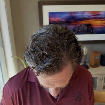Sara Wasserbauer, MD - One year result!!! - Hair Loss Centers Near Me - Walnut Creek, California Sara Wasserbauer, MD - One year result!!! - Hair Loss Centers Near Me - Walnut Creek, California
