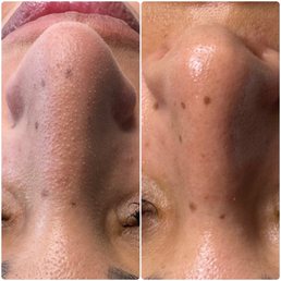 Before and after the enzyme facial Before and after the enzyme facial