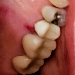 Upland Dental Implant & Orthodontics - Cut to my gum between teeth #13 & #14