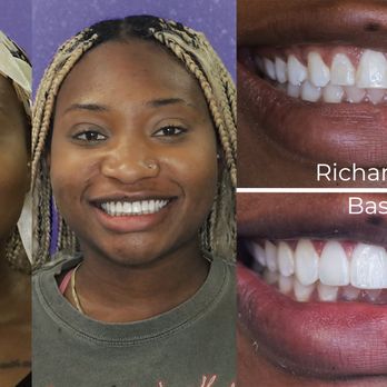 Baseline Dental Practice - Composite Veneers Cosmetic Dentistry Smile Makeover - Orthodontists Near Me - Rancho Cucamonga, California Baseline Dental Practice - Composite Veneers Cosmetic Dentistry Smile Makeover - Orthodontists Near Me - Rancho Cucamonga, California