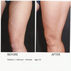 Fox Valley Vein Centers - Before & After
