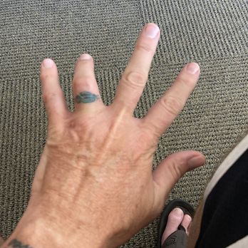 All Star Physical Therapy - Repaired finger. - Physical Therapy Near Me - Murrieta, California All Star Physical Therapy - Repaired finger. - Physical Therapy Near Me - Murrieta, California