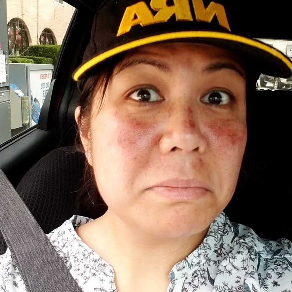 Origin Health Center - This was a few mintues after Microneedling and PRF. I was little sore, but nothing major. - Naturopathic/Holistic Near Me - Oakland, California