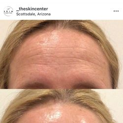 The Skin Center - Skin pen microneedling