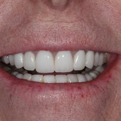 Jason Cellars, DDS - Sea Cliff Dental - After photo of one our patients