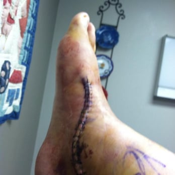 Brandt R Gibson, DPM - I had to have a second surgery on my foot (by a different dr if course) 5 screws later. I would NEVER go to this dr. - Podiatrists Near Me - American Fork, Utah Brandt R Gibson, DPM - I had to have a second surgery on my foot (by a different dr if course) 5 screws later. I would NEVER go to this dr. - Podiatrists Near Me - American Fork, Utah