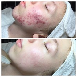 Luminous Skin - Acne bootcamp! From inflamed acne to clear skin