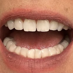 Andrade Dental Family - Before the bonding on my two top front teeth