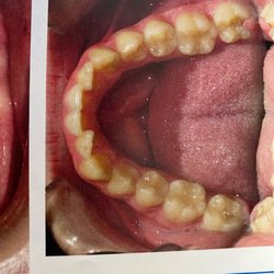 Stieg & Wachtel Orthodontics - Bottom set of teeth before braces.
