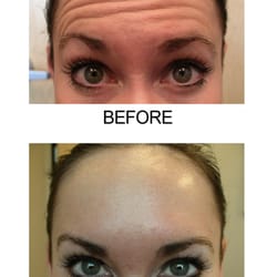 Face By Fong - Botox