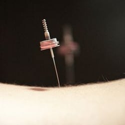 De-Qi Acupuncture - Yi's Warm Needle Technique