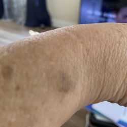 CHI St. Vincent Hot Springs - Bruise 8 days later thumb print! From ER