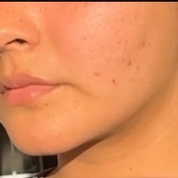 PlasticsMD - A few days ago! Surgery was done in May, this photo was taken late July! - Plastic Surgeons Near Me - Huntington Beach, California