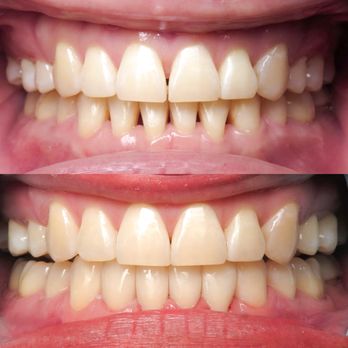 Nick L. Le, DDS - Before and after of Bioclear treatment to close black triangles - Cosmetic Dentists Near Me - Rancho Cucamonga, California Nick L. Le, DDS - Before and after of Bioclear treatment to close black triangles - Cosmetic Dentists Near Me - Rancho Cucamonga, California