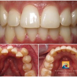 Ricardo Suarez, DDS - Crooked teeth to Straight teeth with Clear Aligner Therapy!