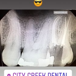 City Creek Dental - Root canal completed by Dr Landon Bye. The sometimes hard to find fourth canal was located and treated for a great outcome.