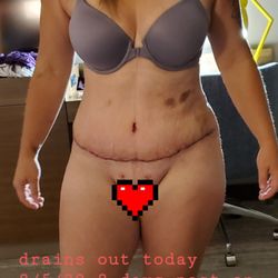 Sargent Craniofacial Surgery - I feel amazing an owe it all to Dr sargent of salt lake city Utah