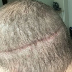 Advanced Medical Hair Institute - 3 months post op 32 mm wide