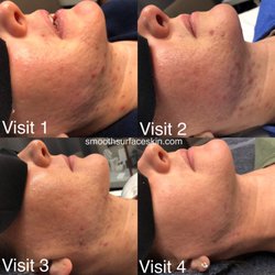 Smooth Surface Skin and Waxing - Acne Management
