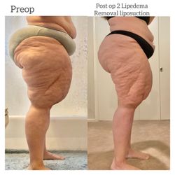 Liza Kim, MD - Before and after 2 Lipedema removal surgeries