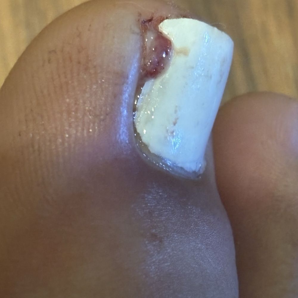 Shimmer Nails & Spa - My toenail the 5th day - Nail Salons Near Me - Garland, Texas Shimmer Nails & Spa - My toenail the 5th day - Nail Salons Near Me - Garland, Texas