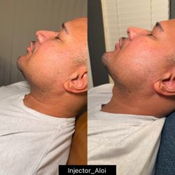 Chin filler