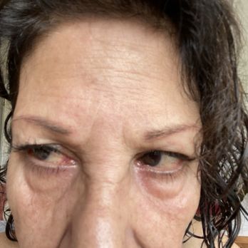 Peter K Davis, MD - Still top of my nose has Botox but not the lines between my eyebrows - Cosmetic Surgeons Near Me - Palo Alto, California Peter K Davis, MD - Still top of my nose has Botox but not the lines between my eyebrows - Cosmetic Surgeons Near Me - Palo Alto, California
