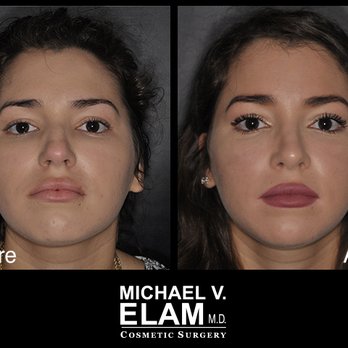 Michael V Elam, MD - Rhinoplasty - 1 Year Post Op - 22 Year Old Woman - Cosmetic Surgeons Near Me - Newport Beach, California Michael V Elam, MD - Rhinoplasty - 1 Year Post Op - 22 Year Old Woman - Cosmetic Surgeons Near Me - Newport Beach, California