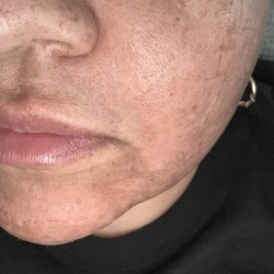 Khronos MedSpa - CO2 laser photo closeup