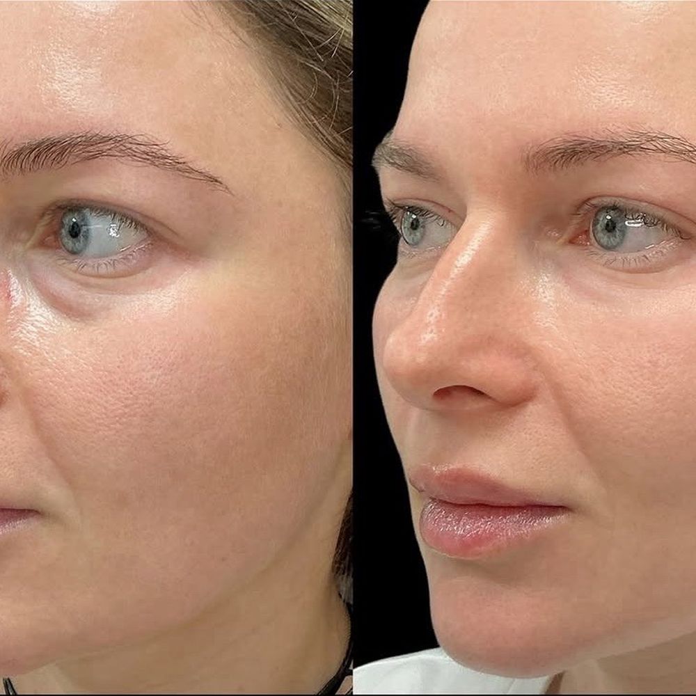 Diamond Advanced Aesthetics - Selphyller gel treatment under the eyes - Medical Spas Near Me - New York, New York
