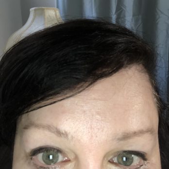 James Scheu, MD, FACS - Lower brow and smaller eye this isn't due to camera angle my eye and brow is smaller-lower - Plastic Surgeons Near Me - St. Louis, Missouri