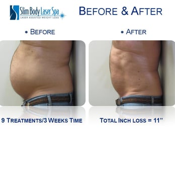 Tred's Slim Body Laser Spa - 11 inches lost in 3 weeks - Medical Spas Near Me - Stuart, Florida