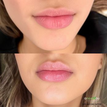 Anew You - Lip Injection Before & After. All lip injections performed by Dr. Sherry. - Weight Loss Centers Near Me - San Antonio, Texas Anew You - Lip Injection Before & After. All lip injections performed by Dr. Sherry. - Weight Loss Centers Near Me - San Antonio, Texas