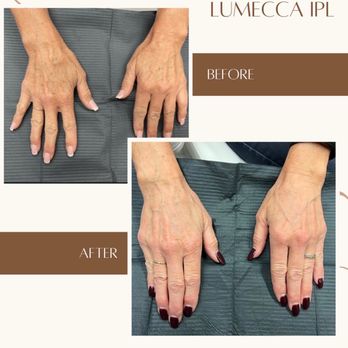 HD Aesthetic Wellness - Hyperpigmentation treatment - Medical Spas Near Me - Denver, Colorado