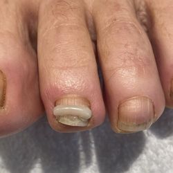 High Maintenance Nail Salon - ONYFIX TO HELP CORRECT PINCER TOENAILS!