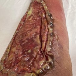 Ventura Health And Rehabilitation Center - Clearly infected but they refused to acknowledge it was infected. Thankfully my Aunt is back in the hospital.