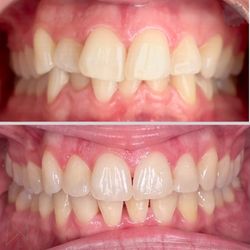 Las Positas Family Dental - Invisalign and Gingivectomy Before/After