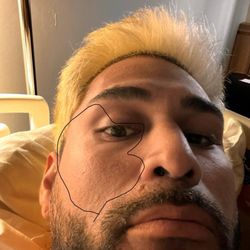 Academic Hospital - Swollen face