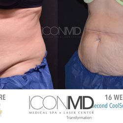 Icon MD Medical Spa + Laser Center - Davie - Coolsculpting