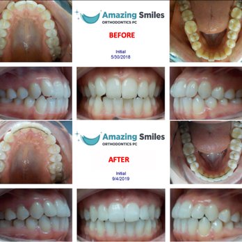 Amazing Smiles Orthodontics - Before and after aligners - Orthodontists Near Me - Forest Hills, New York