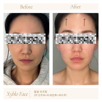 Bear Body Skin - Non surgical face lift. - Body Contouring Near Me - Fullerton, California Bear Body Skin - Non surgical face lift. - Body Contouring Near Me - Fullerton, California