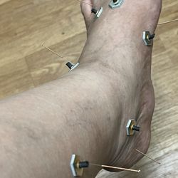 Raymond Webster - Acupuncture