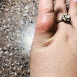 Chemical burn picture that I took while at the salon
