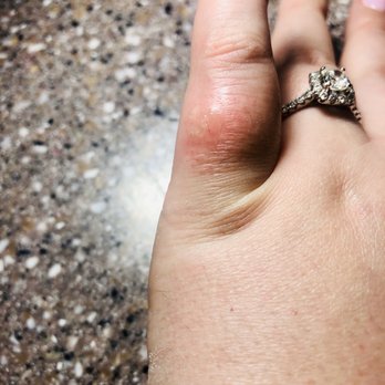 Angel Nails - Chemical burn picture that I took while at the salon - Waxing Near Me - Fort Worth, Texas